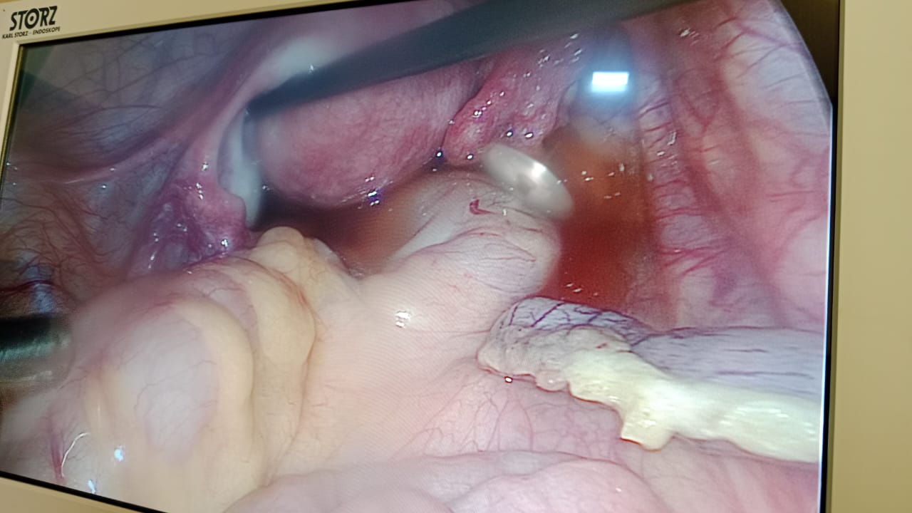 laparoscopic appendectomy in surat