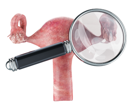 Ovarian Cyst Surgery